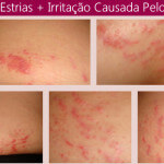Vitanol A No Tratamento das Estrias