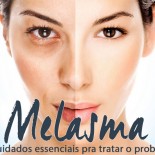 Melasma: 8 Cuidados Essenciais Pra Tratar o Problema