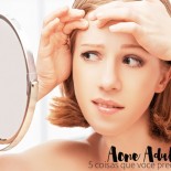 Acne Adulta: 5 coisas que você precisa saber!