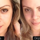 Laser CO2 Fracionado: Antes e Depois!