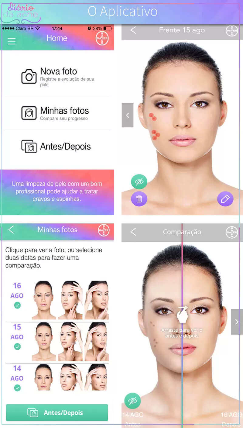 diário da acne bayer 2