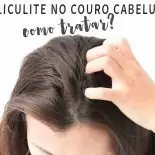 Foliculite no Couro Cabeludo: Como Tratar?